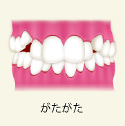 がたがた の歯