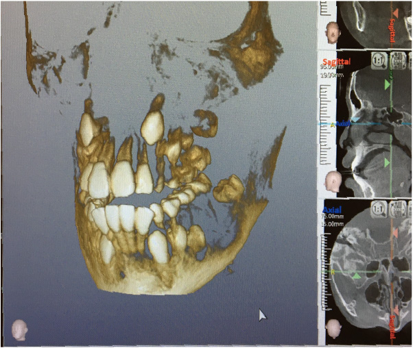 CTの立体画像から3次元的な歯の位置を確認